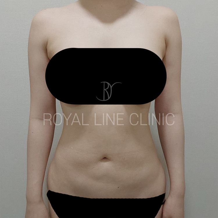 Liposuction in Korea — an evidence-based guide