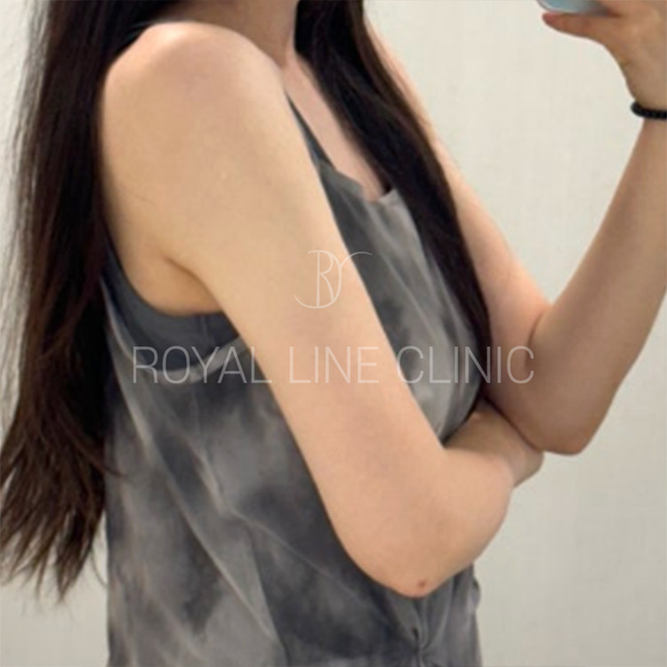 Chin and face liposuction