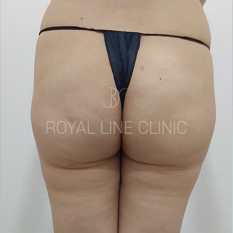 Body contouring case — reference only