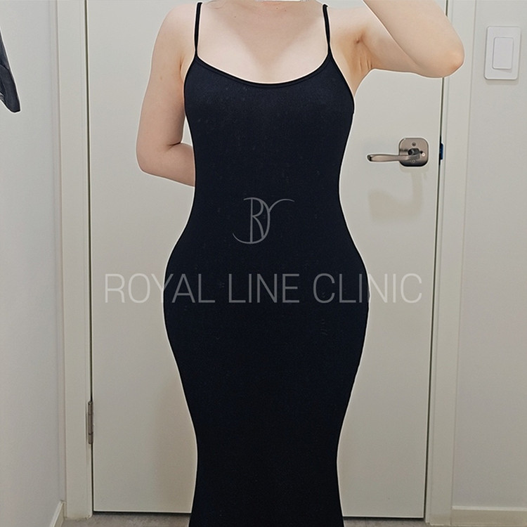 Royal Line body contouring result — Gangnam, Seoul