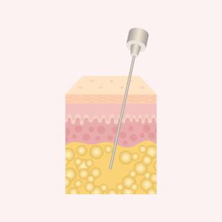 Step 1 — double-suction extraction